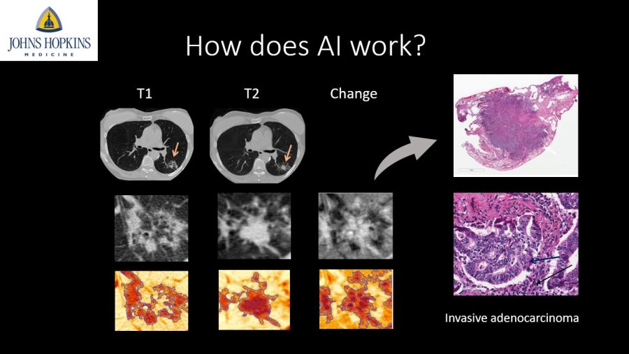 One of the major reasons why AI can improve prediction accuracy is that it can capture complicated image texture patterns. If we look at this example with non-solid nodules imaged in 3 consecutive years and then progressed to an invasive adenocarcinoma, we see that changes across years are not adequately quantified by diameter, attenuation, and margin that are used by standard clinical practice.